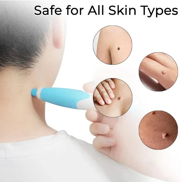 Remove your skin tags painlessly at home 